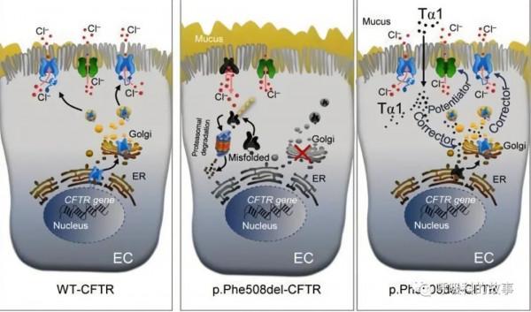 反覆發作鼻竇炎、咳嗽、支氣管擴張,這個病我們要提高認識 反覆發作鼻竇炎、咳嗽、支氣管擴張,這個病我們要提高認識
