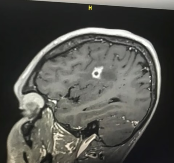 35歲男子訂婚旅行 卻意外染上罕見絕症 大腦&quot&semi;發黴&quot&semi; 比新冠還可怕