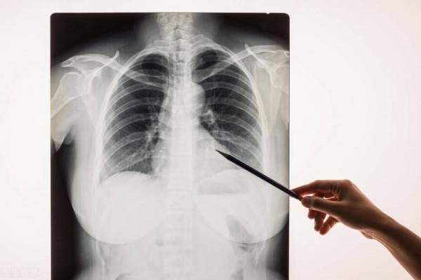 女子接觸黴變玉米後肺部長滿真菌,花錢多還很難根治,原因何在 女子接觸黴變玉米後肺部長滿真菌,花錢多還很難根治,原因何在