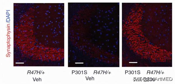 Sci Transl Med｜單核RNA測序揭示阿爾茲海默症TREM2 R47H變體新機制