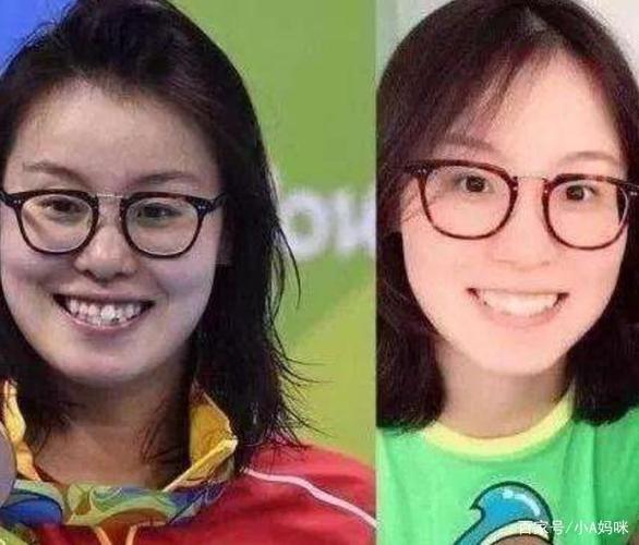 傅園慧整牙後&OpenCurlyDoubleQuote;洪荒少女&rdquo;變&OpenCurlyDoubleQuote;仙女&rdquo;，網友表示錯怪baby了