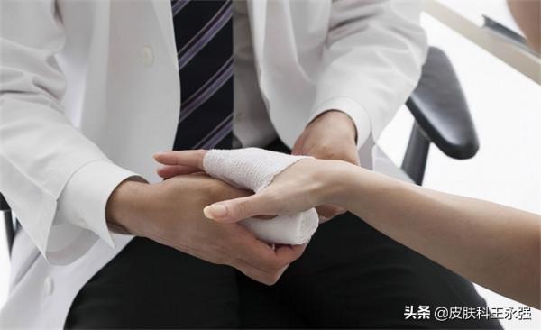 汗皰疹反覆性發作，瘙癢難耐，醫生教你用3個方法解決，快速有效