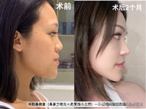 隆鼻就能提升面部立體感?不,有效和無效手術,關鍵在於它 隆鼻就能提升面部立體感?不,有效和無效手術,關鍵在於它