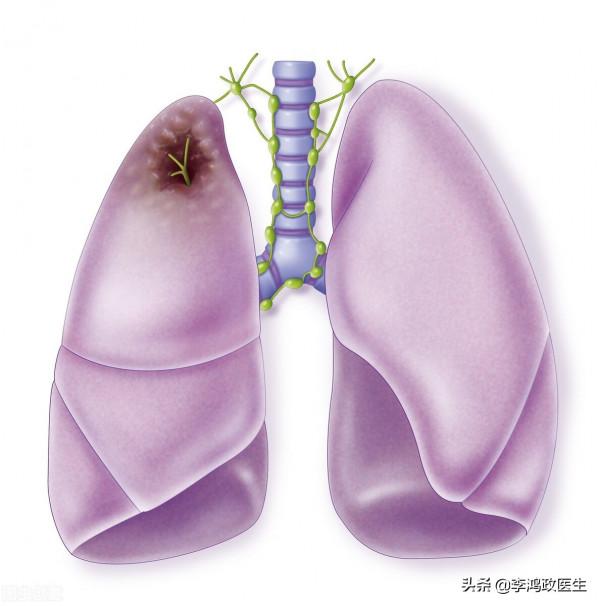 男子頭痛以為腦腫瘤,開顱後惡臭液體流出,醫生後背冷汗:誤診了 男子頭痛以為腦腫瘤,開顱後惡臭液體流出,醫生後背冷汗:誤診了