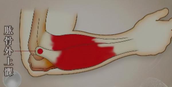 網球肘的運動療法