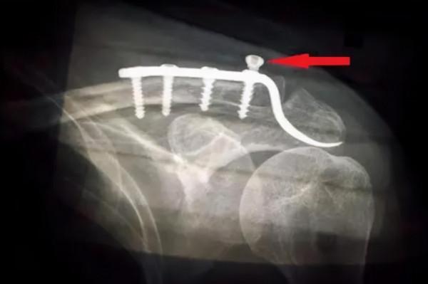 骨折後,鋼板不取出留在體內會怎樣?有沒有副作用? 骨折後,鋼板不取出留在體內會怎樣?有沒有副作用?