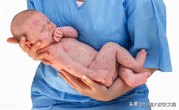 孩子冬季起紅疹子的四個階段