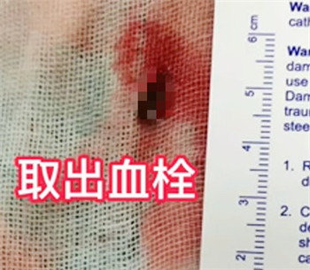 再創生命時速！多科聯動助力卒中患者跑贏&OpenCurlyDoubleQuote;死神&rdquo;