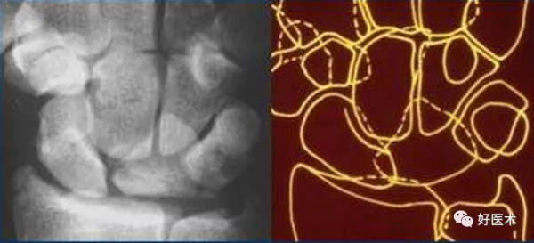 贊！腕關節X線高畫質解剖+腕骨脫位典型病例