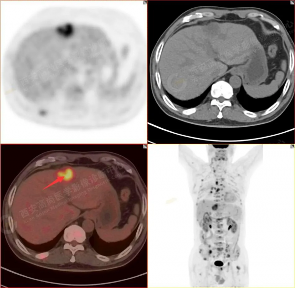 肺結節看診（13）：肺小結節全身廣泛轉移2例，PET分期：晚期