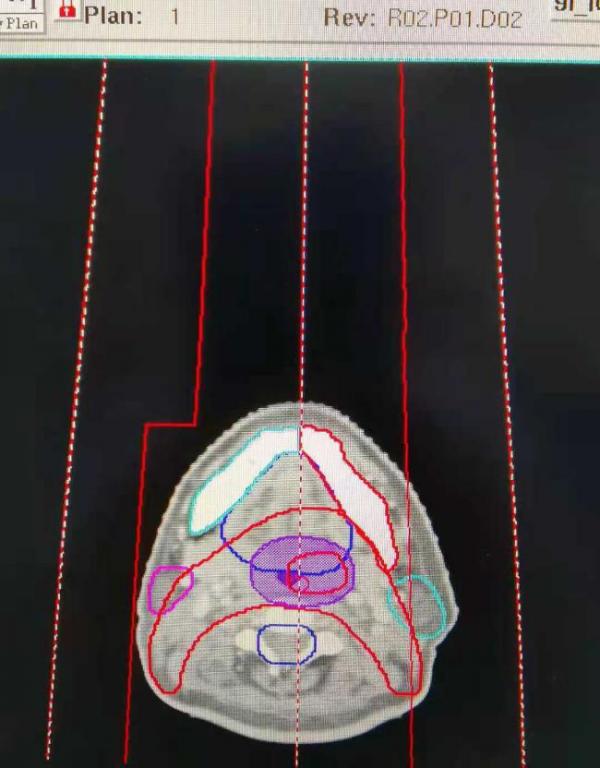 關注喉癌，別讓“咽炎”耽誤病情