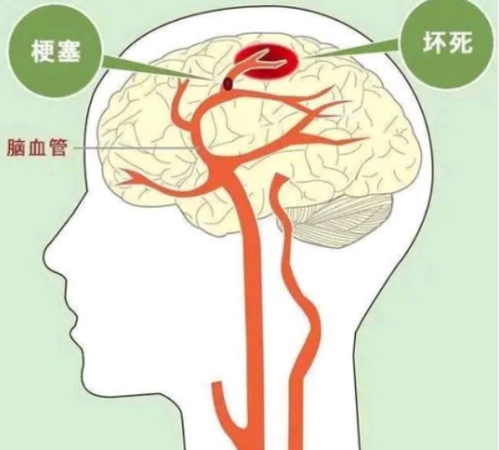 50歲後查腦CT，出現這4種問題，不需要特殊治療，別被坑了