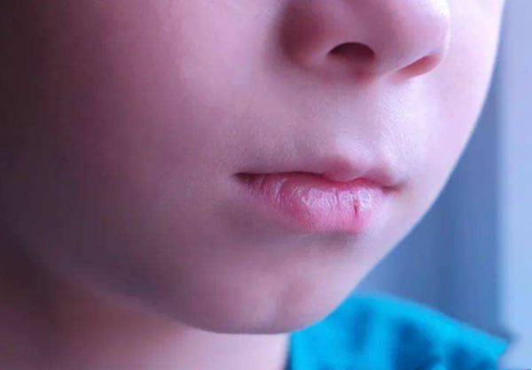 孩子嘴唇裂口又出血，還忍不住撕嘴皮，大夫的處理方式有些意外