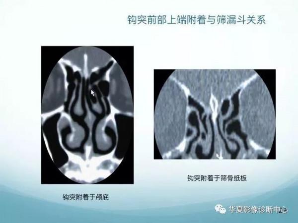 頭頸五官CT斷層解剖圖及常見病影像診斷