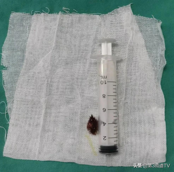 一顆“蒼耳子”幹倒史大爺 一顆“蒼耳子”幹倒史大爺