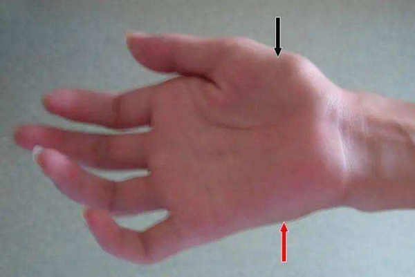 手部無力,上肢萎縮,手掌呈爪狀?醫生提醒:警惕“平山病” 手部無力,上肢萎縮,手掌呈爪狀?醫生提醒:警惕“平山病”