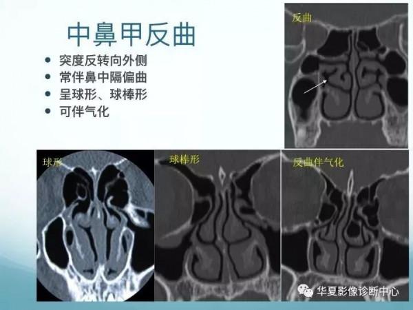 頭頸五官CT斷層解剖圖及常見病影像診斷