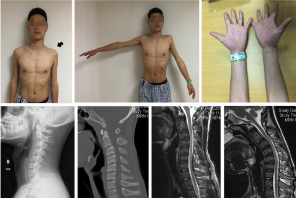 手部無力,上肢萎縮,手掌呈爪狀?醫生提醒:警惕“平山病” 手部無力,上肢萎縮,手掌呈爪狀?醫生提醒:警惕“平山病”