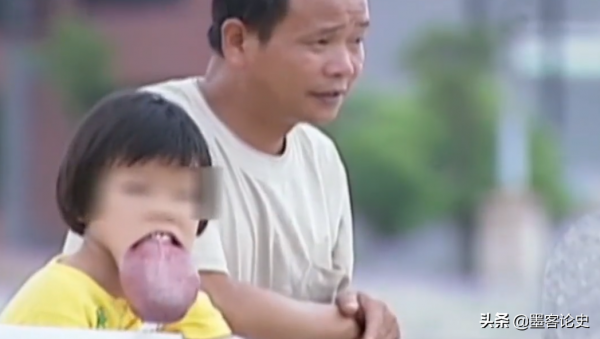 江西8歲女孩患血管瘤，下巴長出長舌狀肉瘤，隨年齡增長垂吊胸前