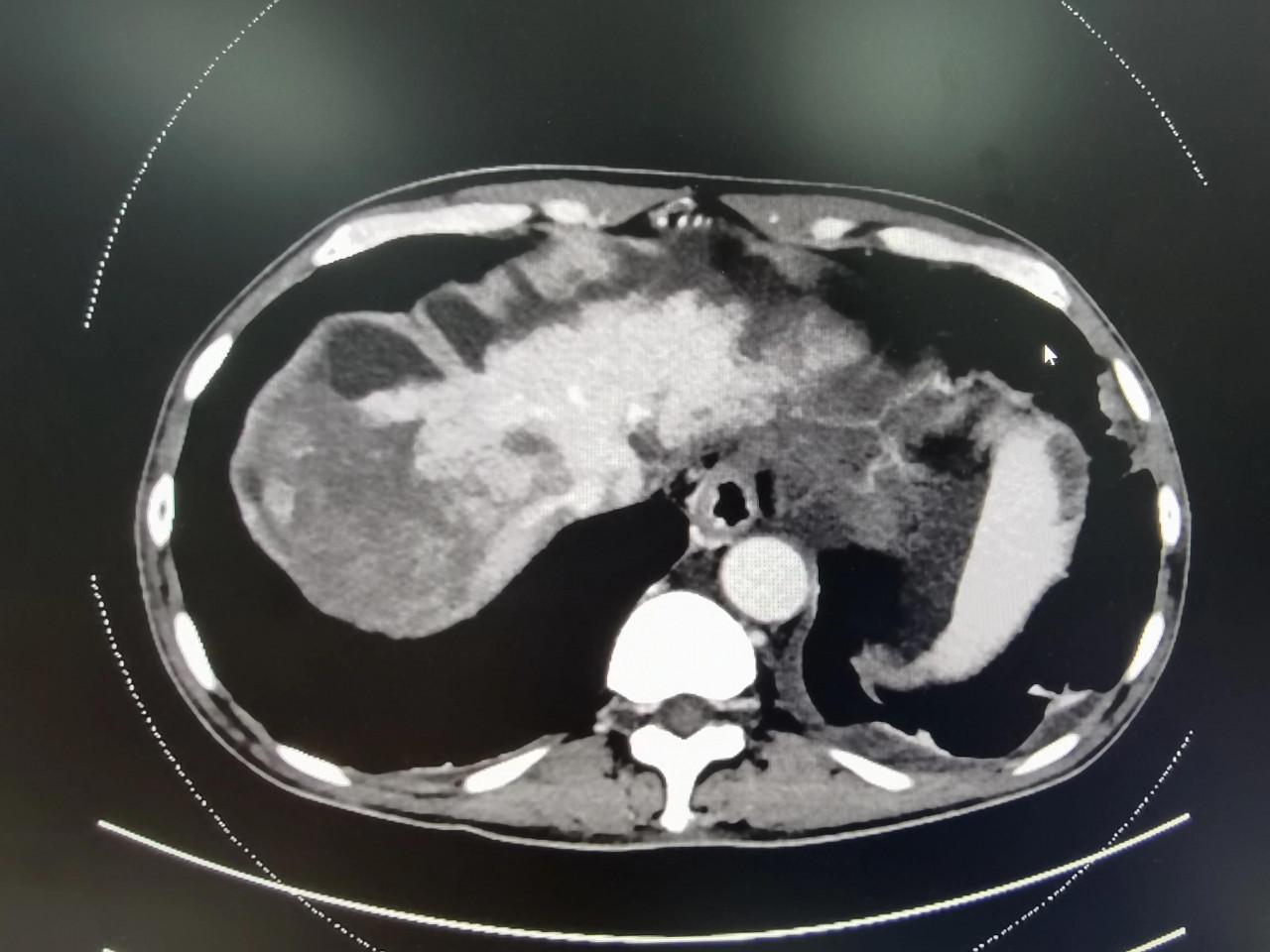 晚期肝癌的介入治療