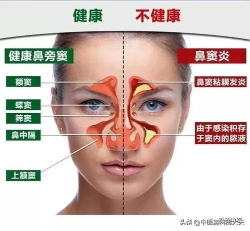 兒童鼻竇炎6個高發的原因 兒童鼻竇炎6個高發的原因