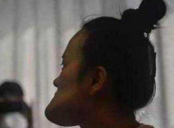 “歪臉女孩”趙宏秋:整容成功後,放棄百萬年薪,甘願教書育人 “歪臉女孩”趙宏秋:整容成功後,放棄百萬年薪,甘願教書育人