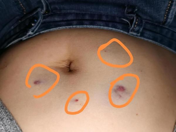 德爾塔病毒中標第13天