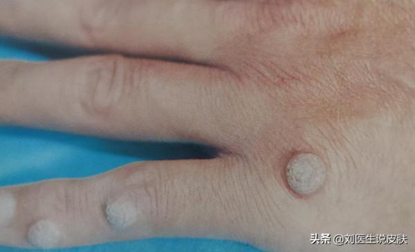“瘊子”、“休子”…都是疣!4種常見的疣,你中招了沒?如何治 “瘊子”、“休子”…都是疣!4種常見的疣,你中招了沒?如何治