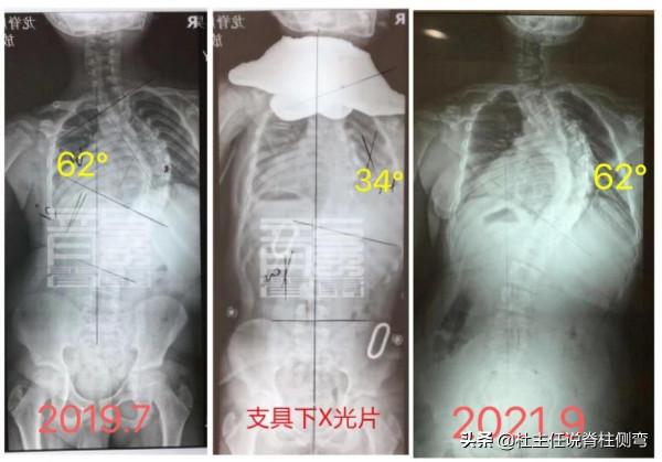 病例分享:62°脊柱側彎孩子兩年治療經歷 病例分享:62°脊柱側彎孩子兩年治療經歷