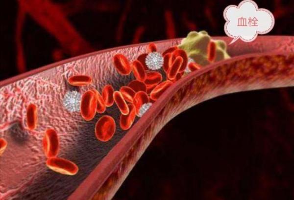 常吃這幾種食物可能會引發血栓，醫生：建議少吃，不妨看看