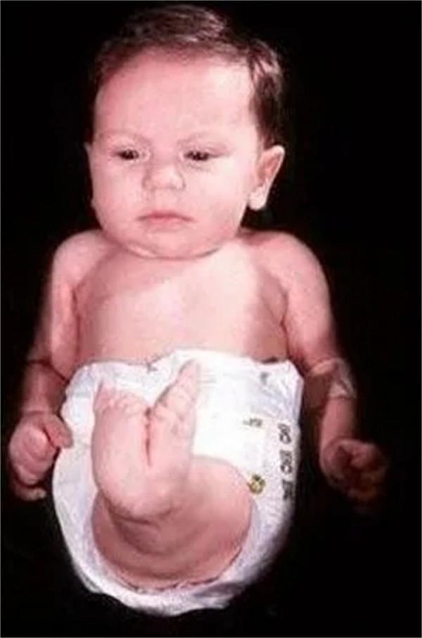 “美人魚”皮平:8年做150次手術,被斷言活不過1歲,卻活了10年 “美人魚”皮平:8年做150次手術,被斷言活不過1歲,卻活了10年