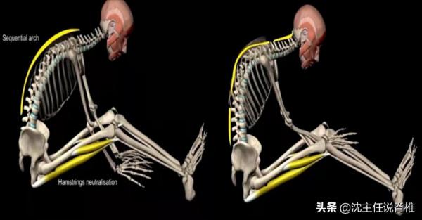 駝背影響體態和氣質,該怎麼改善? 駝背影響體態和氣質,該怎麼改善?