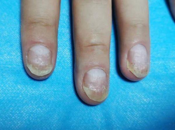 偶買噶!我的指甲為什麼總也治不好?4種甲病要對症治療 偶買噶!我的指甲為什麼總也治不好?4種甲病要對症治療