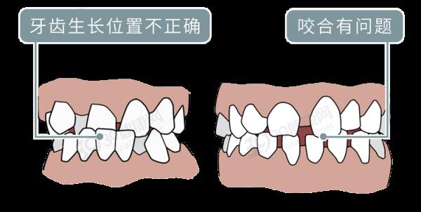 為什麼只要戴牙套,牙齒就可以恢復得很整齊?生動展示矯正過程 為什麼只要戴牙套,牙齒就可以恢復得很整齊?生動展示矯正過程
