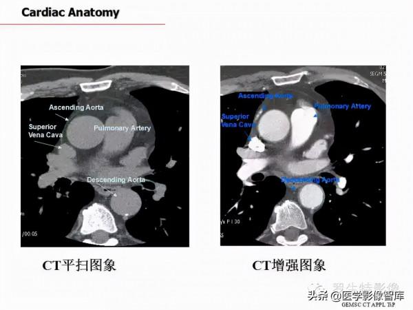 CT斷層解剖圖譜最全總結「推薦收藏」 CT斷層解剖圖譜最全總結「推薦收藏」