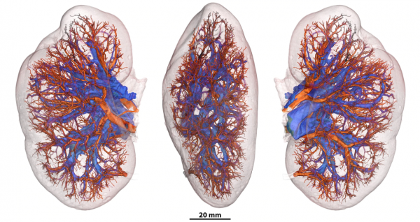 他們用人類史上最強的X光，告訴我們新冠患者的肺傷成了什麼樣