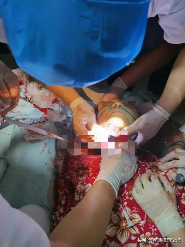 高齡婆婆頸部外傷命懸一線 多學科聯合趕赴現場保平安