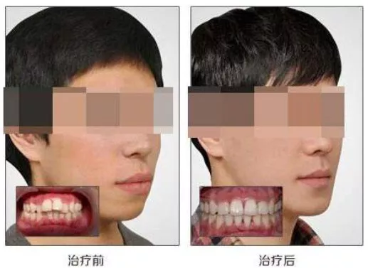 小仙女告訴你，改變牙齒真的可以改變臉型