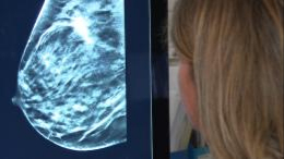 法國參與跨國研究 更精準篩查乳腺癌 法國參與跨國研究 更精準篩查乳腺癌