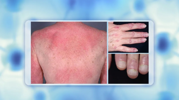 身上長出小疙瘩、紅斑，不痛不癢就沒事？警惕是惡性腫瘤潛伏體內