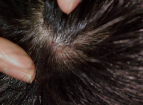 為什麼頭皮總長“疙瘩”和“膿包”？或與4個原因有關