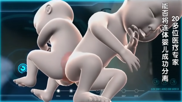 連體兒分離手術難度有多高？江西女嬰臀部相連，唯一的肛門咋分？
