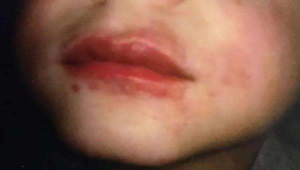 小麥過敏導致反覆喘息
