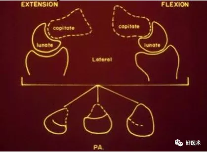 贊！腕關節X線高畫質解剖+腕骨脫位典型病例