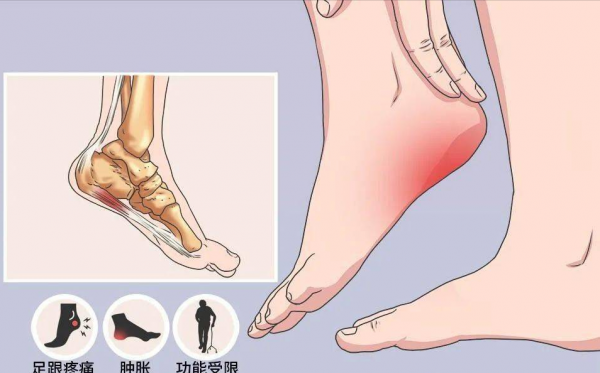 走路腳後跟疼，到底是什麼原因？醫生：帶你揪出跟痛症的真相
