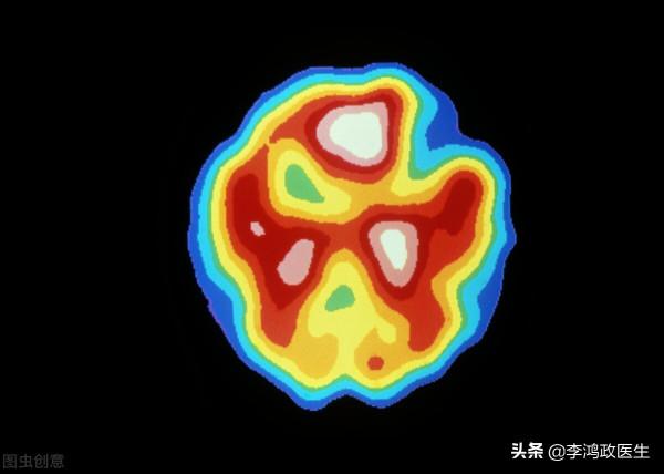 男子頭痛以為腦腫瘤,開顱後惡臭液體流出,醫生後背冷汗:誤診了 男子頭痛以為腦腫瘤,開顱後惡臭液體流出,醫生後背冷汗:誤診了