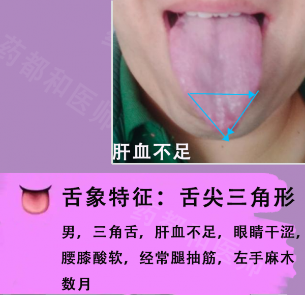 膽囊息肉,膽結石,肝囊腫?6種肝膽病變,看看舌象就知道 膽囊息肉,膽結石,肝囊腫?6種肝膽病變,看看舌象就知道