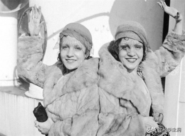 連體人一個去世怎麼辦？連體姐姐死後，妹妹被迫和遺骸生存2天