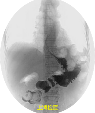花甲老人腹瀉七年查因無果，竟然是這種罕見的“瘻”