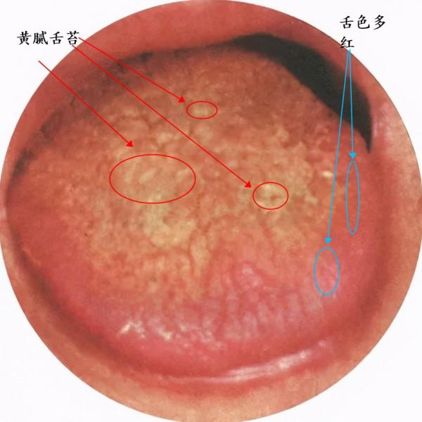 溼熱、寒溼、痰溼：病因不同、症狀不同、調理方法也不同